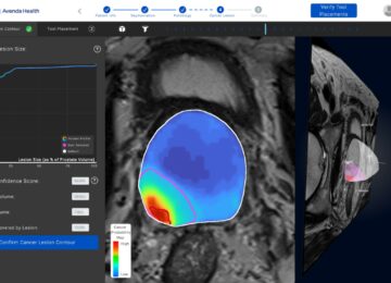 Avenda Health Raises $10M, Gets FDA Clearance To Begin Clinical Trial of Laser Heat Technology